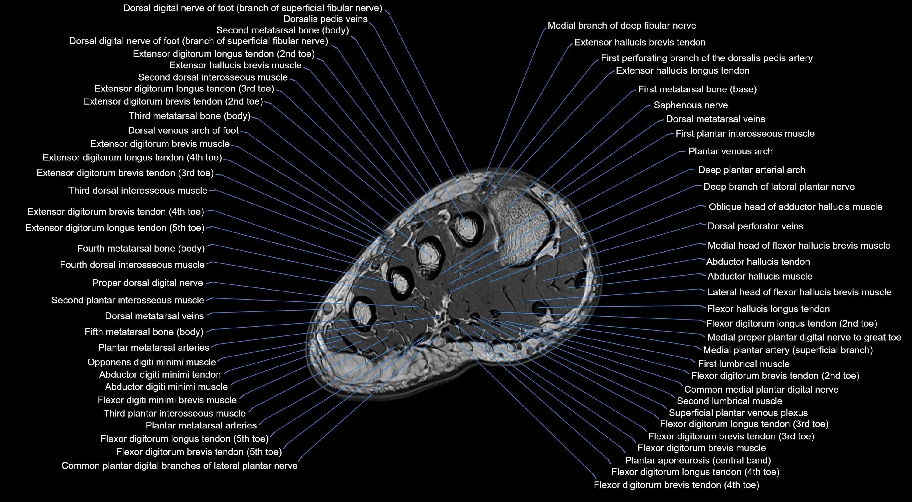 MRI mid foot coronal ligaments cross sectional anatomy 3T  radiology  image-img-00001-00007.webp